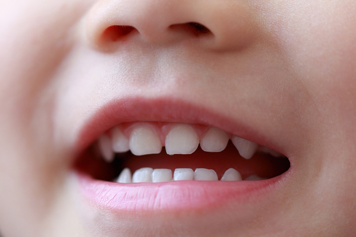 おしゃぶりが長引くと、どんな歯並びになる？