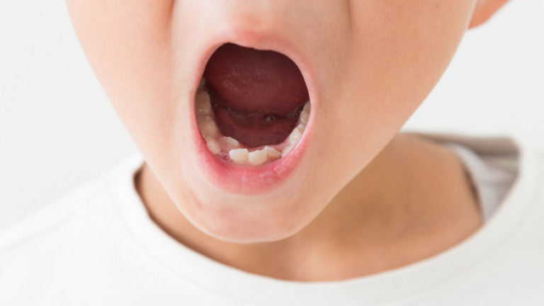 子どもの歯肉炎はそのままにしていると危険？＃歯科衛生士の教室