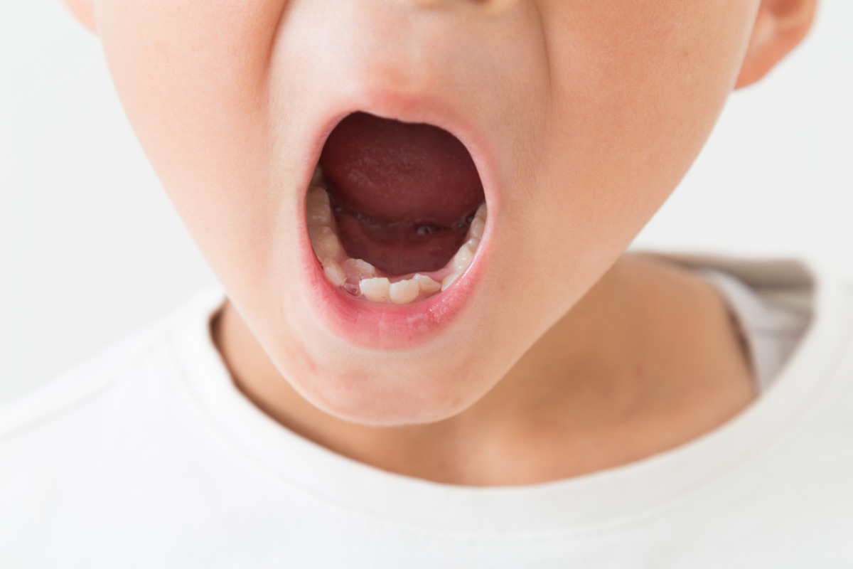 子どもが歯肉炎になる原因